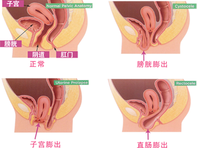 盆底肌修复