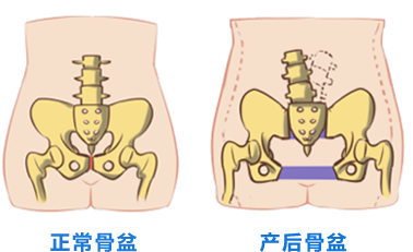 骨盆修复