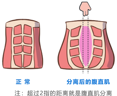 腹直肌修复