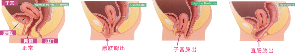 盆底损伤表现