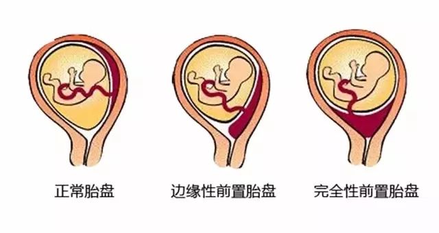 当“熊猫血＂遇上前置胎盘