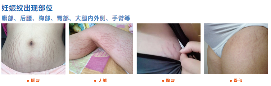 妊娠纹出现部位