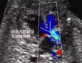 什么情况下孕妈必须接受心脏超声检查