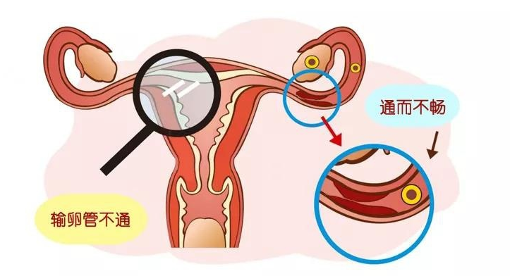 输卵管通而不畅