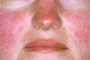玫瑰痤疮