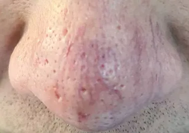 红斑毛细血管扩张型