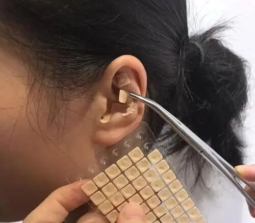 耳穴压豆